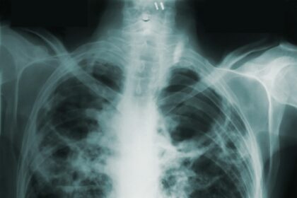 Speranta TV | Incidenţa cazurilor de tuberculoză crește în România, pentru al treilea an la rând. Una dintre cauze este poluarea
