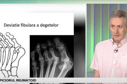 Speranta TV | Sănătate cu prioritate - Piciorul reumatoid - Invitat: Marius Uscatu